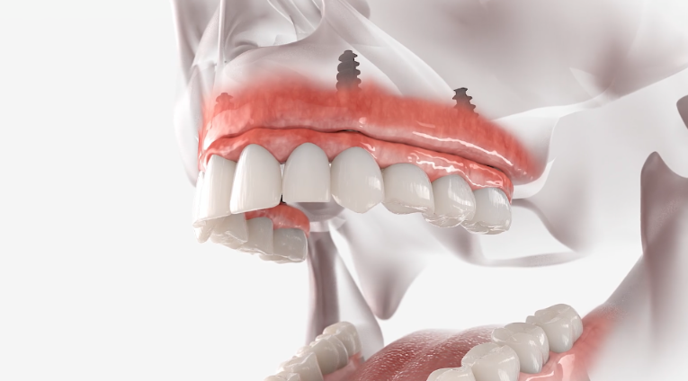 Medical illustration showing full-mouth implant-supported teeth