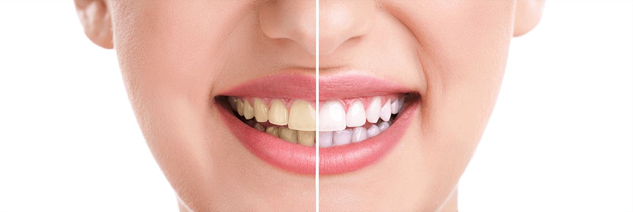 Teeth Whitening in Roseville